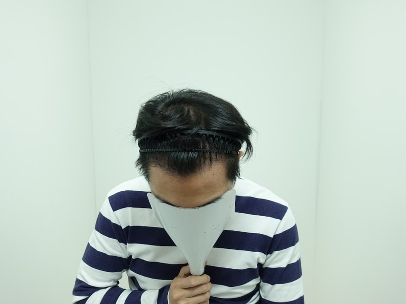 &lt;수술 1년 2개월 후&gt;
