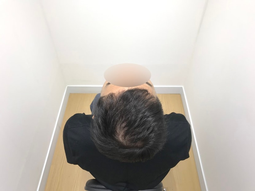 &lt;수술 8개월 후&gt;