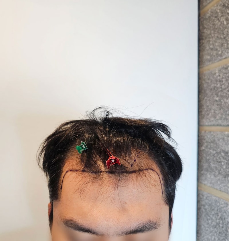 毛髪移植