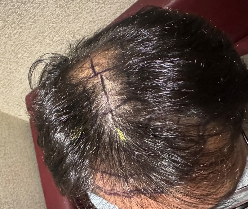 뉴헤어모발성형외과 모발이식 2200모낭 5일차