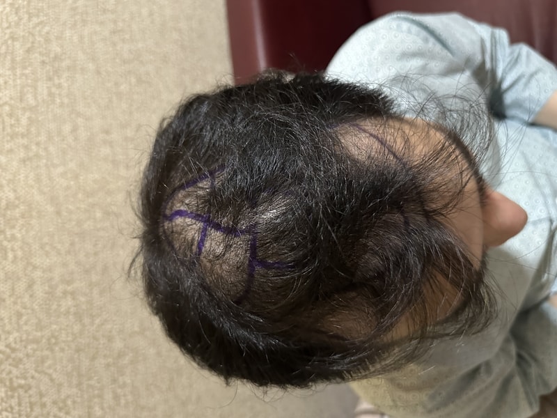 뉴헤어모발 성형외과 모발이식 5000모 7월 23일 후기