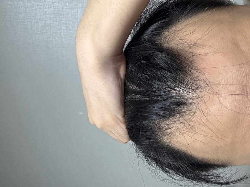 안녕하세요 약은 꾸준히 10년정도 먹고있는데 이정도 털린거면 몇모정도 심어야할까요?