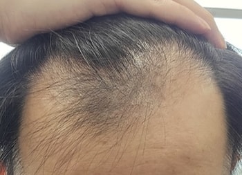 수술 전