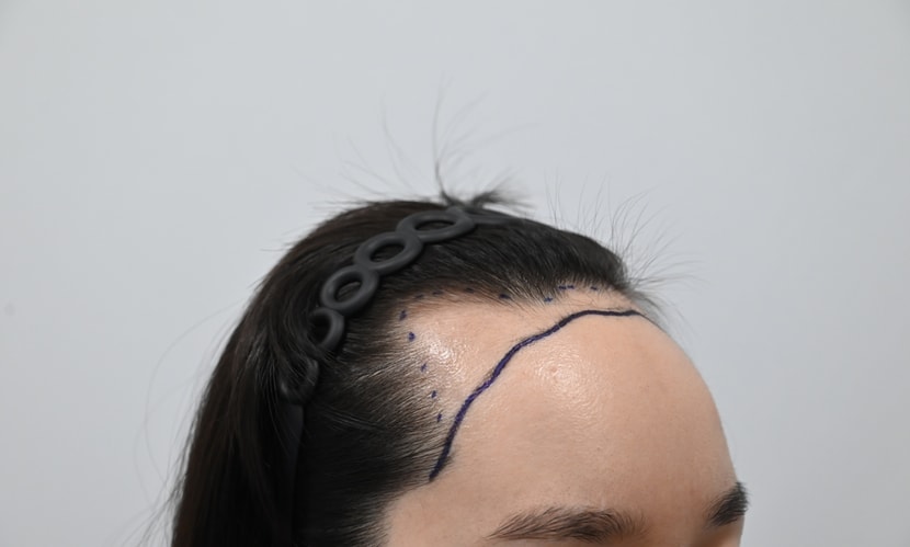 &lt;수술 전 디자인 옆&gt;