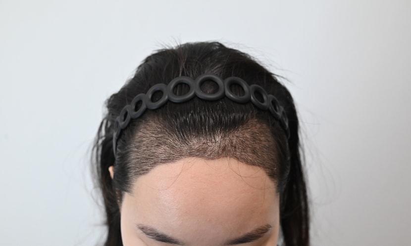 &lt;수술 후 2주차&gt;