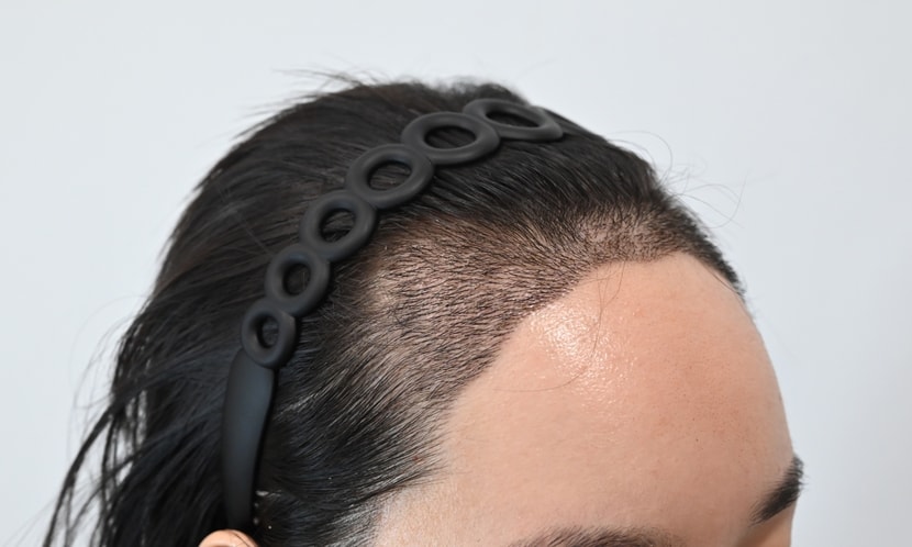 &lt;수술 후 2주차 옆&gt;