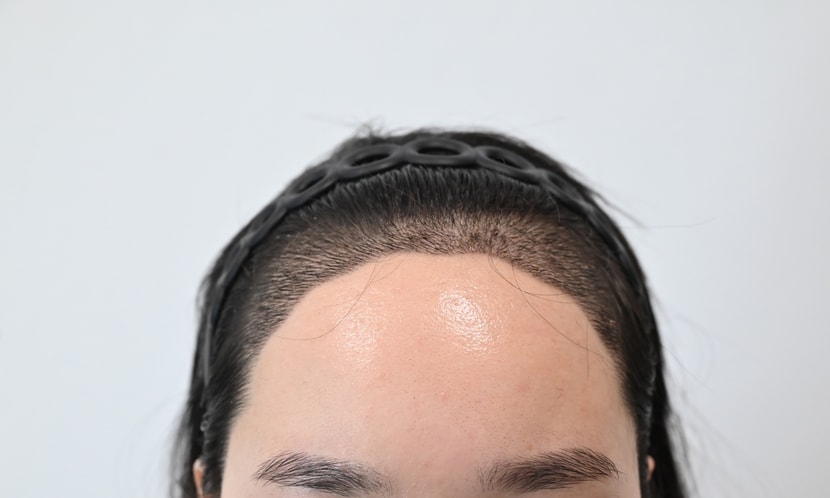 &lt;수술 후 2주차&gt;