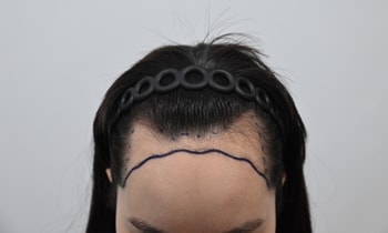 &lt;수술 전 디자인&gt;