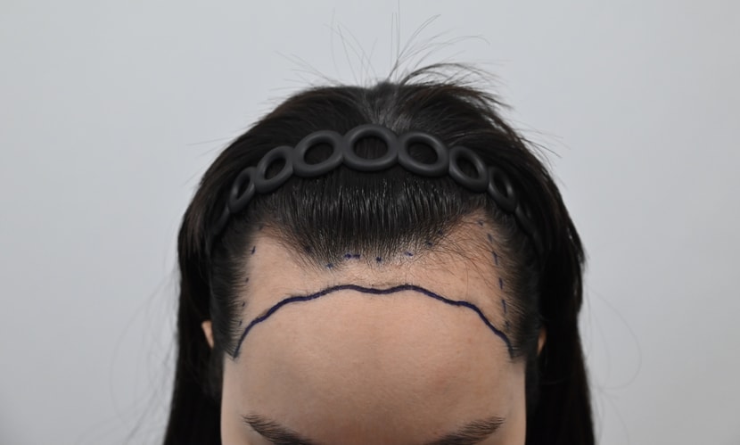 &lt;수술 전 디자인&gt;