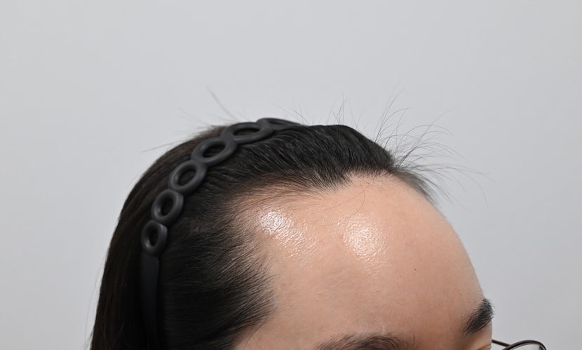 &lt;수술 전 옆&gt;