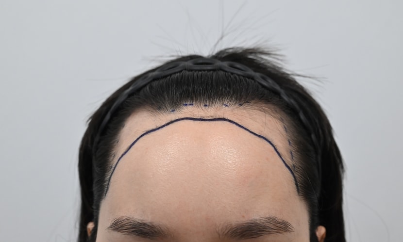 &lt;수술 전 디자인&gt;