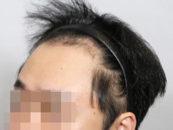수술전