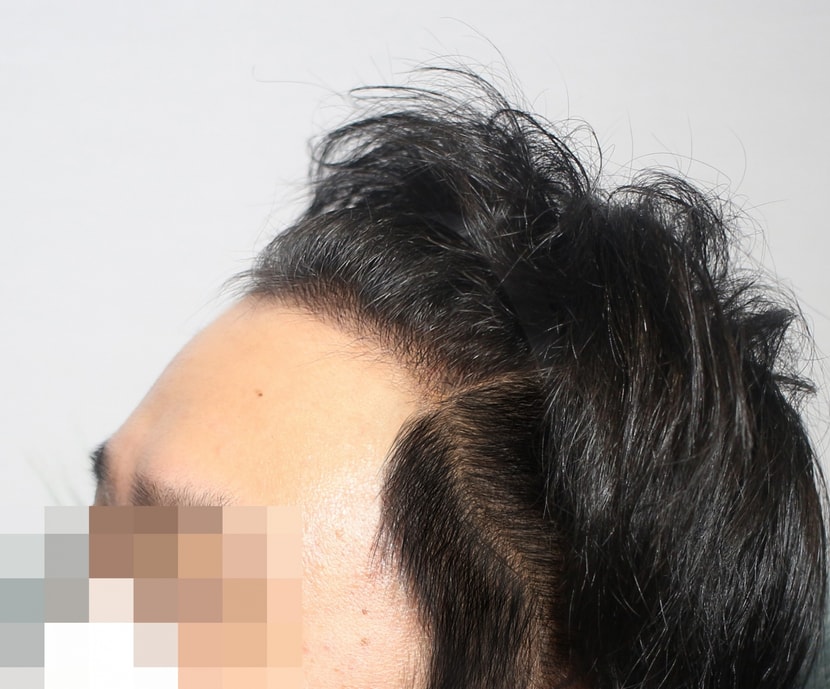 수술후