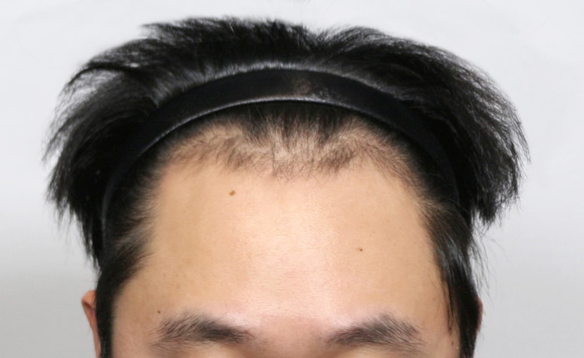 수술전