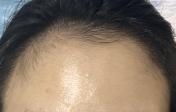 만 3개월차 헤어라인이 차오르는 모습