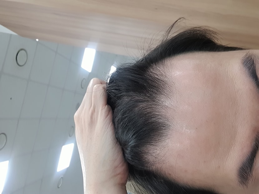 이식전