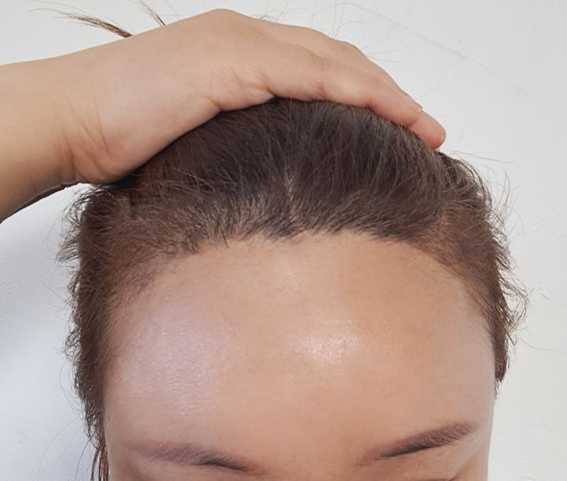 헤어라인 모발이식