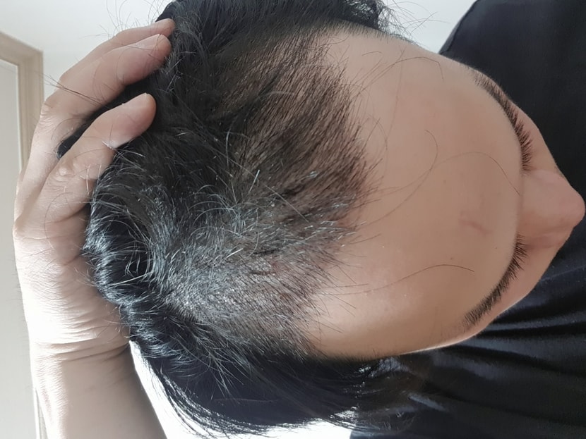 아직 딱쟁이가 남아있음