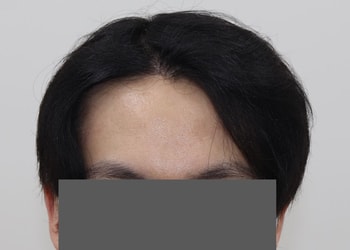 수술 후(9개월)