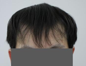수술 전