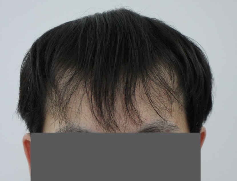 수술 전
