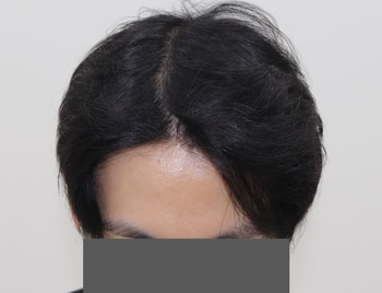 수술 후(9개월)
