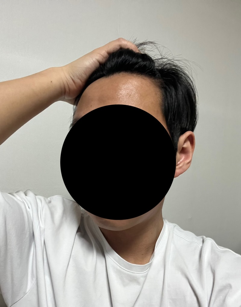 多娜整形外科发线 1400 毛囊 42天后期