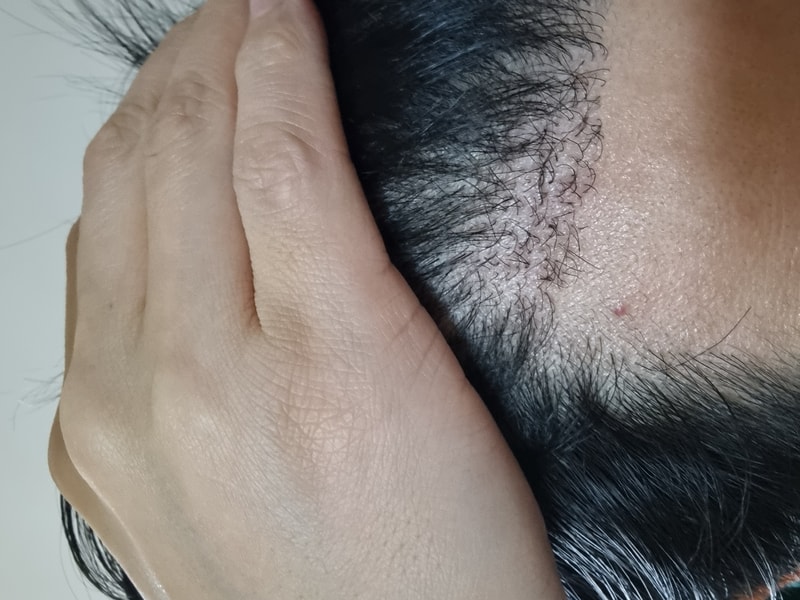 移植已经8个月了 因为卷曲太严重了 所以很苦恼