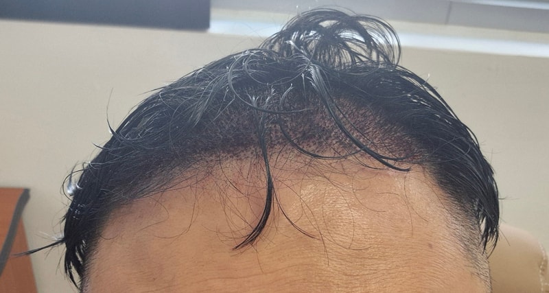 为了担心黑暗期的人们 (多娜整形外科2800 毛囊 男士大量移植)