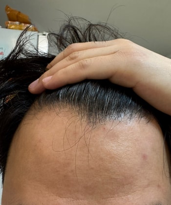 수술전 비대칭이마