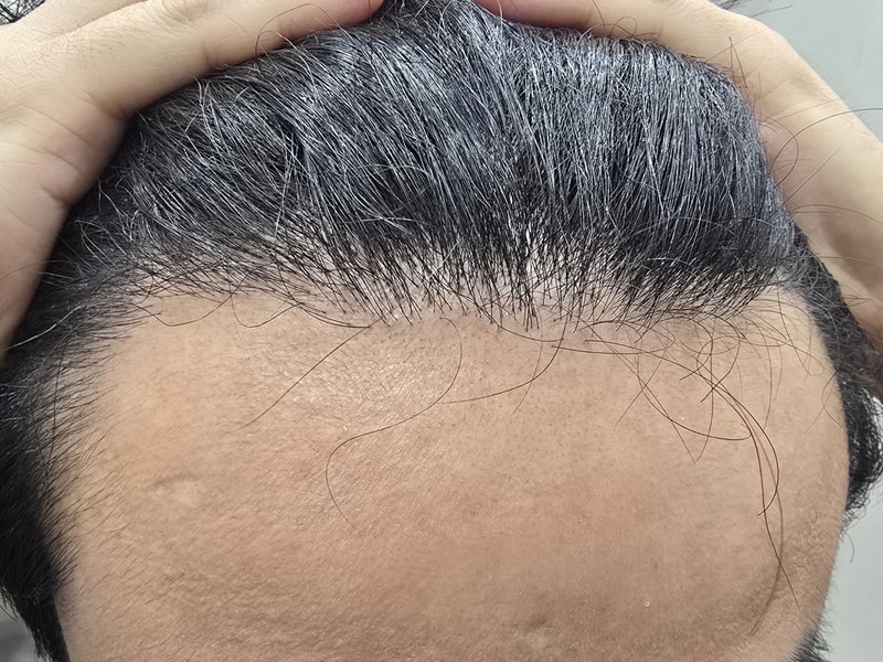 모발이식 재수술 결심했습니다.