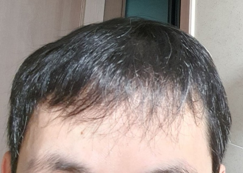 모발이식으로 탈모탈출한 노력들