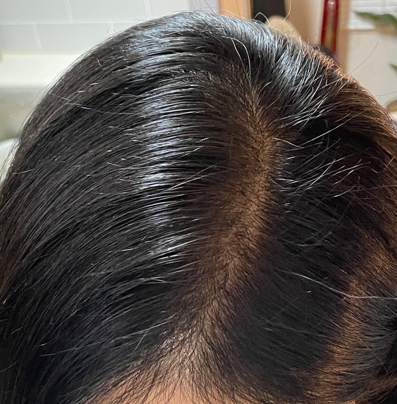 모발이식 잘 될까요?