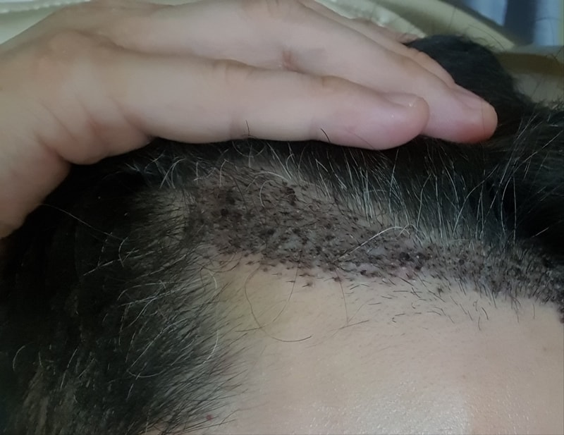 비절개 800모낭 10일차입니다