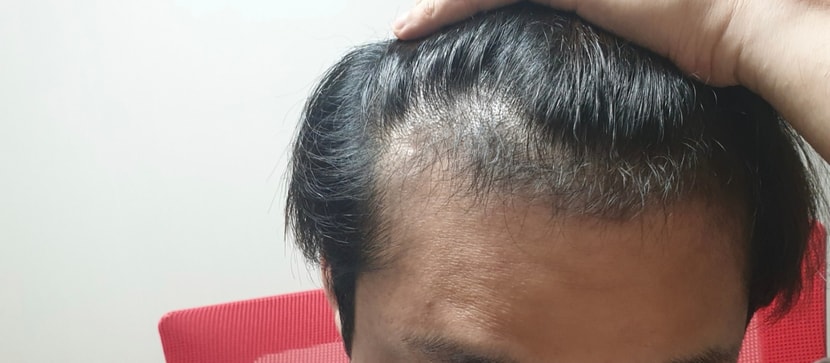 2020년05월 시술전