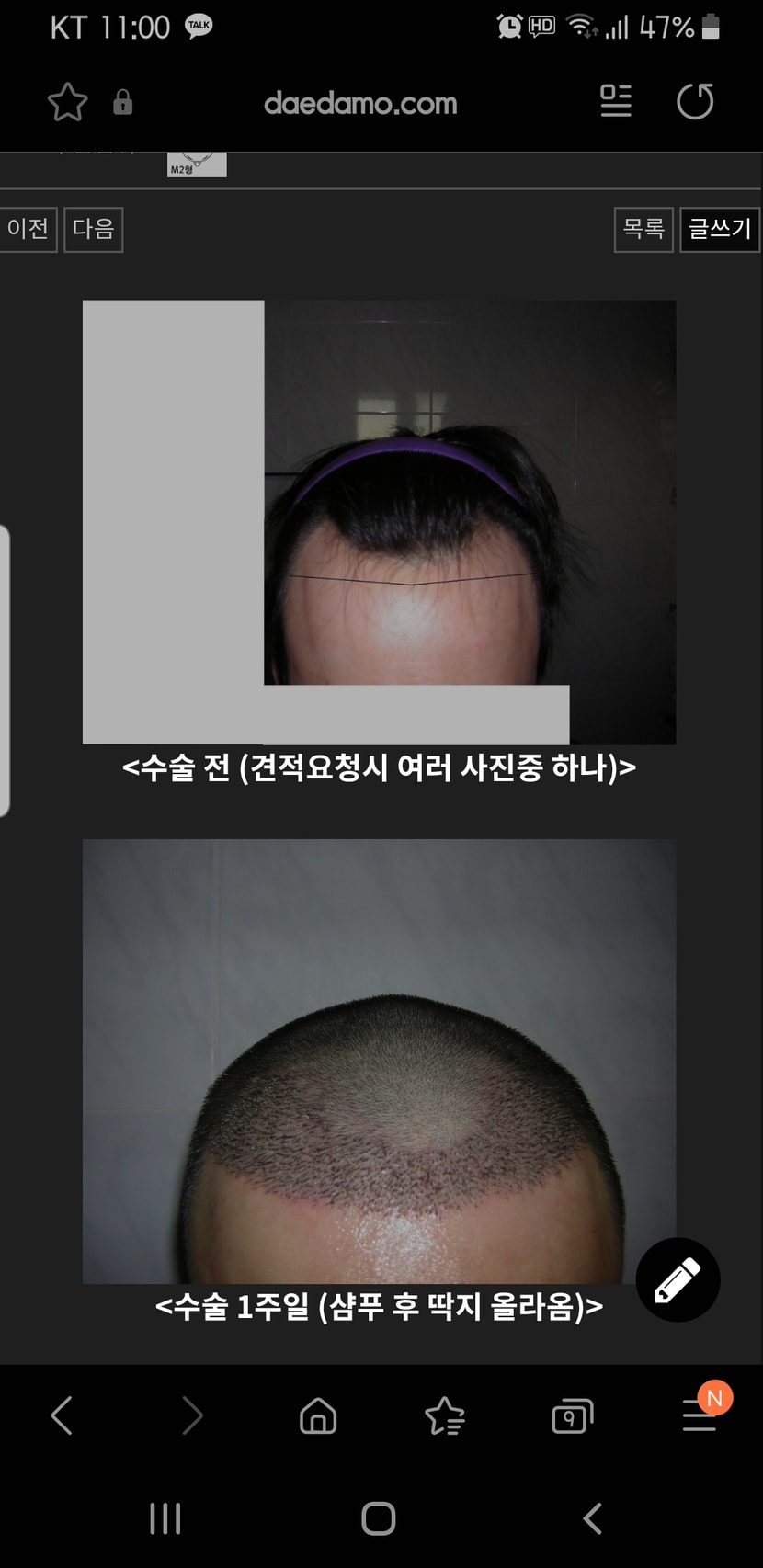 2012년 1차 수술