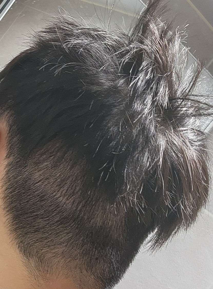 수술이후 19일 이후.
