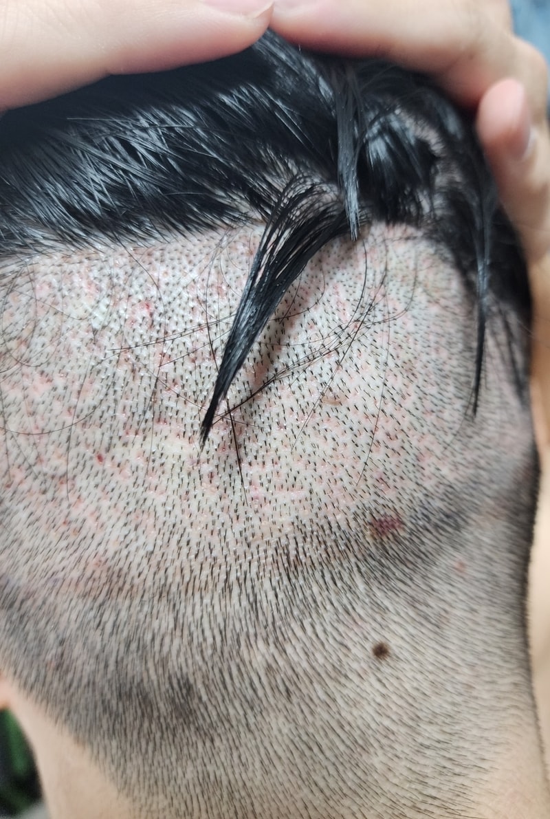非切開植毛後の後ろ髪