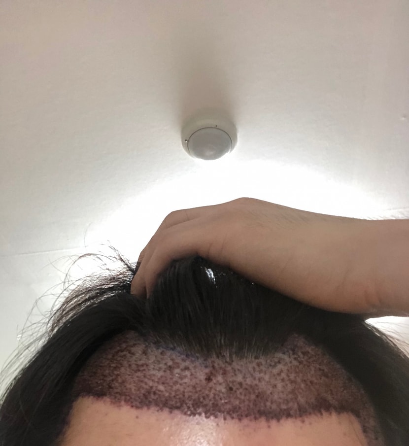 시술 전