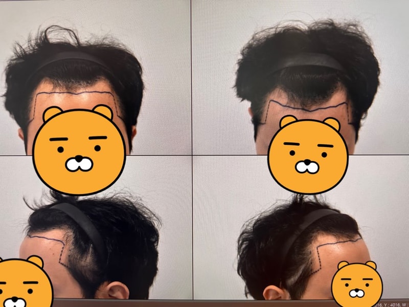 [Review] A review of the first year of the 3400-mo MoM clinic for hair transplantation