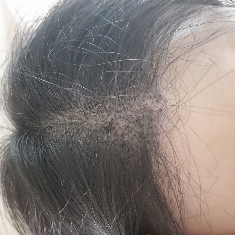 뉴헤어모발이식 3000모