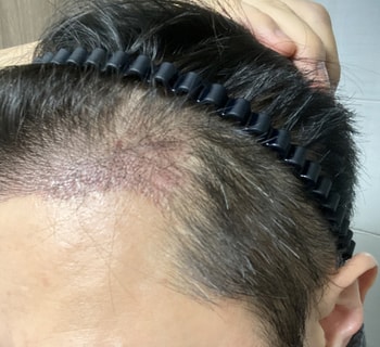 좌측은 상당히 빠졌다. 자연스러운 암흑기를 원했지. 각질제거라는 이유로 빡빡문데서 없어진 기분이 영 좋지않다.