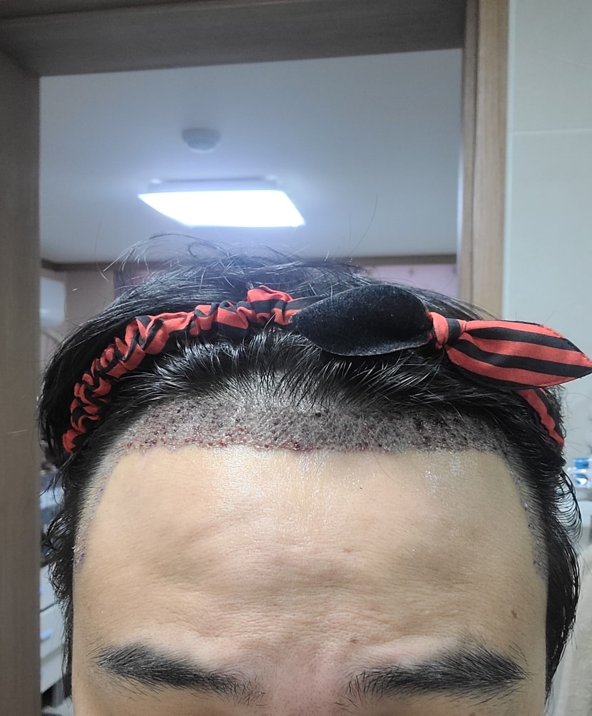 이식3일후
