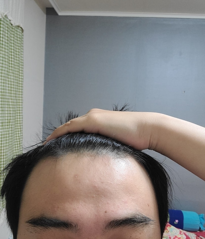 이식전