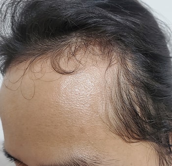 수술전