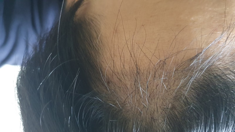 Jp 3개월차 모발이식 후기