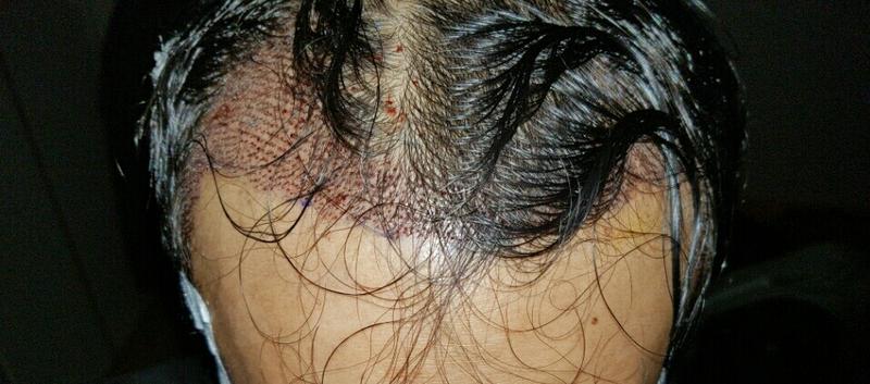 今日jpで4000毛の手術をしました 大体の密度はどうですか？*極嫌悪主義*