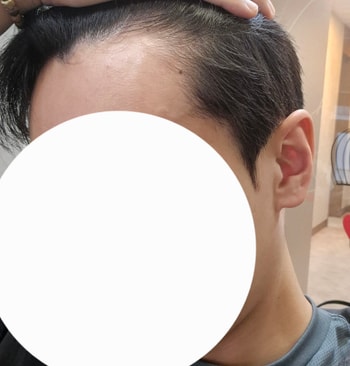 0일차 수술 전 측면샷