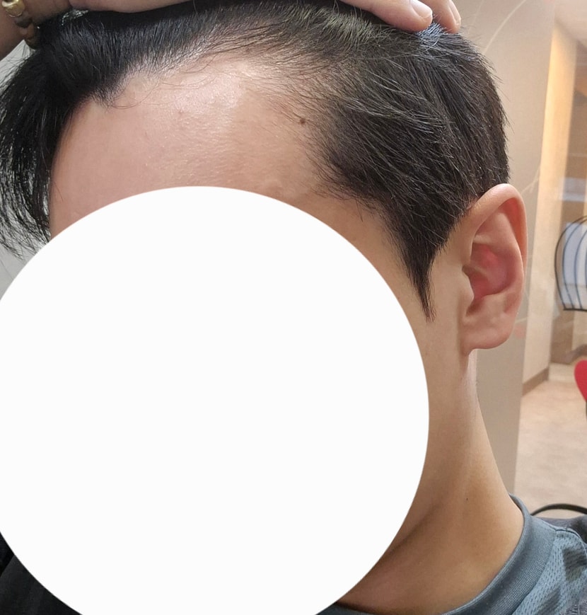 0일차 수술 전 측면샷