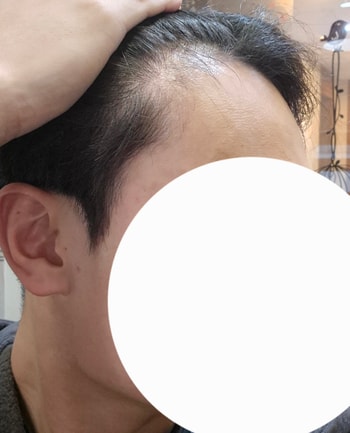 0일차 수술 전 측면샷